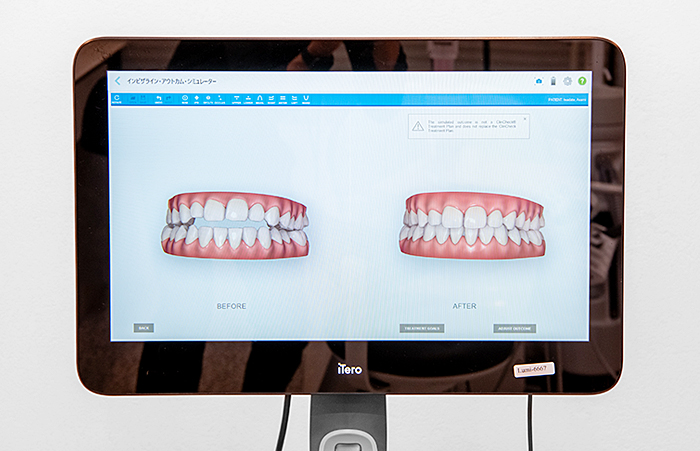 口腔内3Dスキャナー