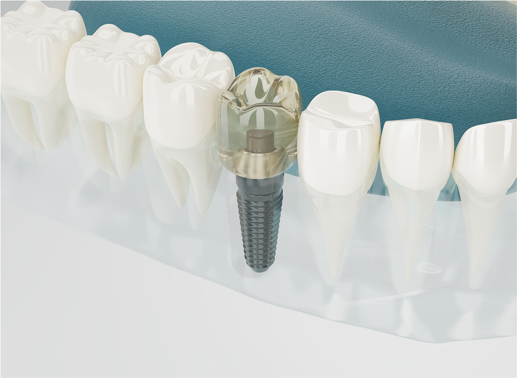 他院で埋入された