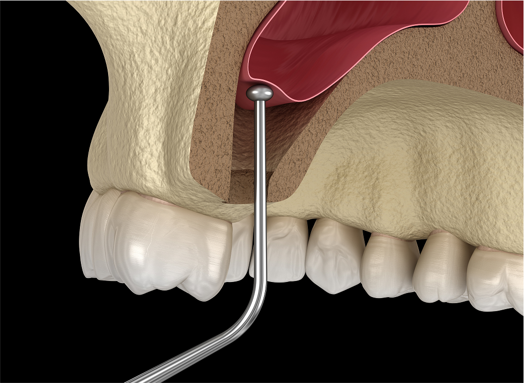 サイナスリフト