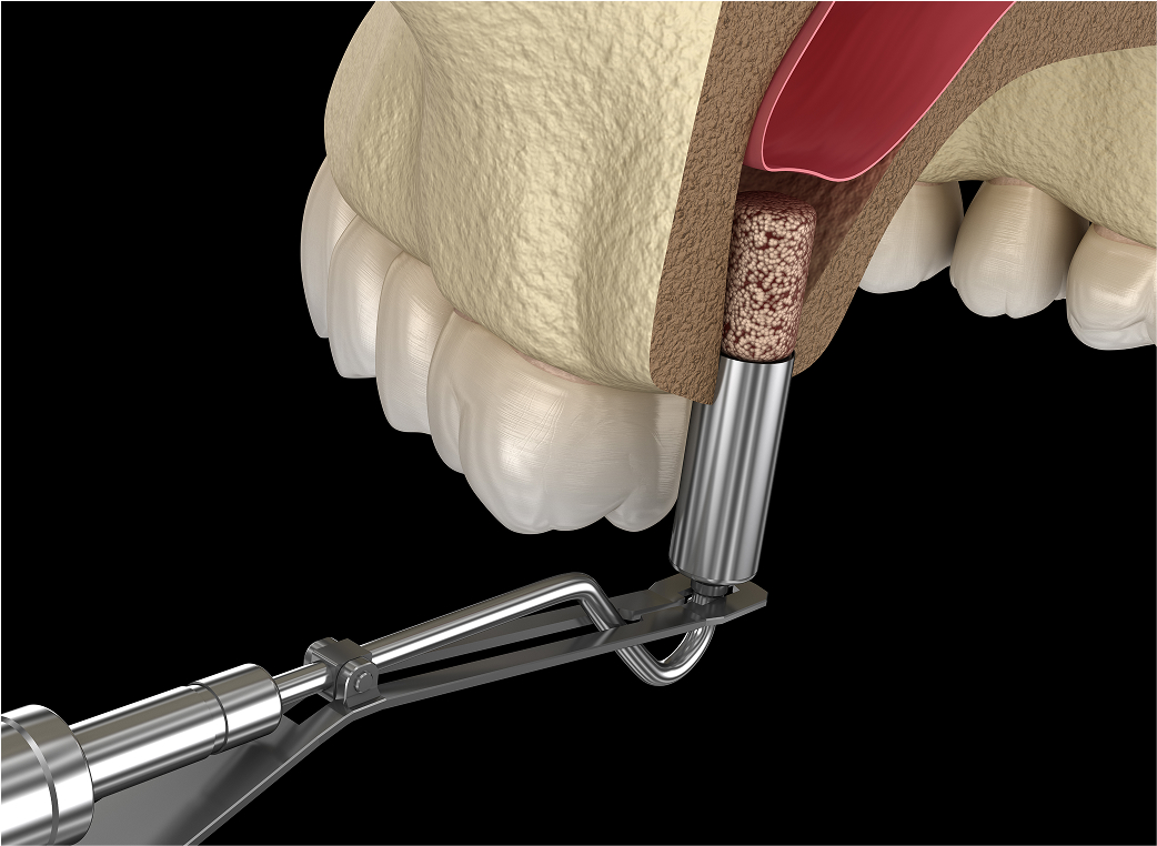 ソケットリフト