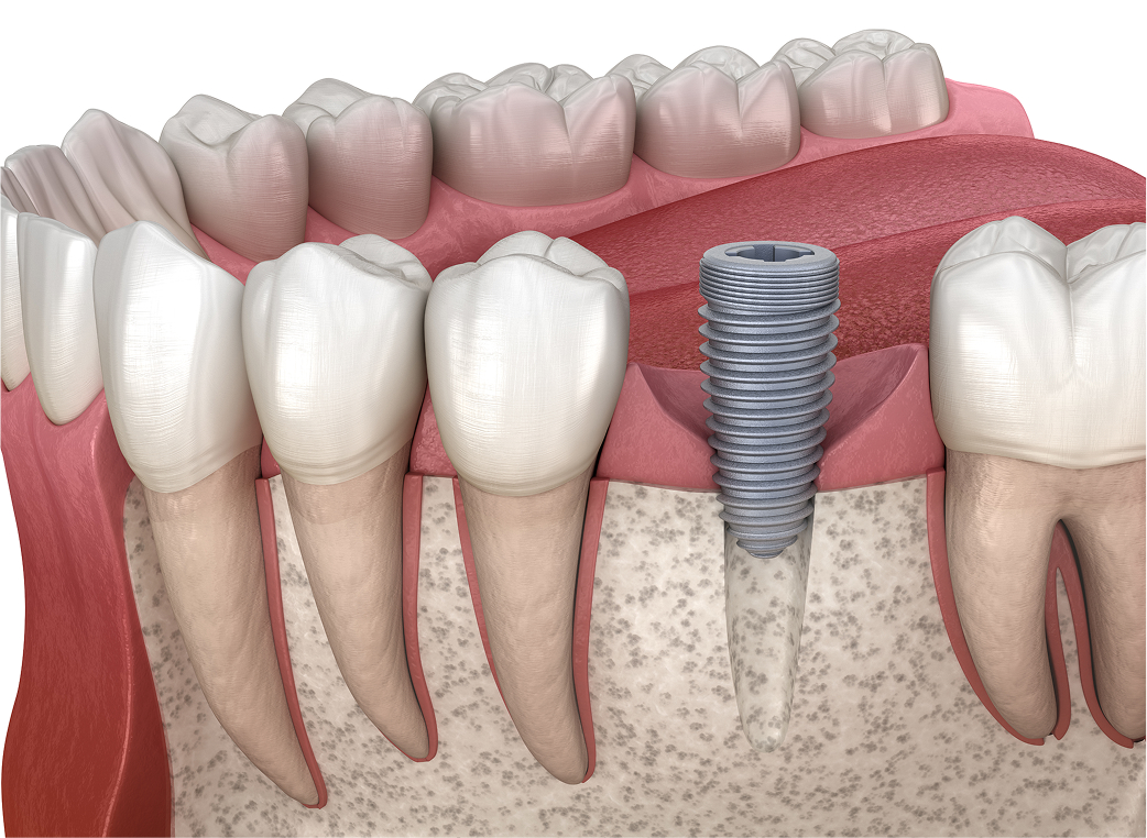インプラント体の埋入手術