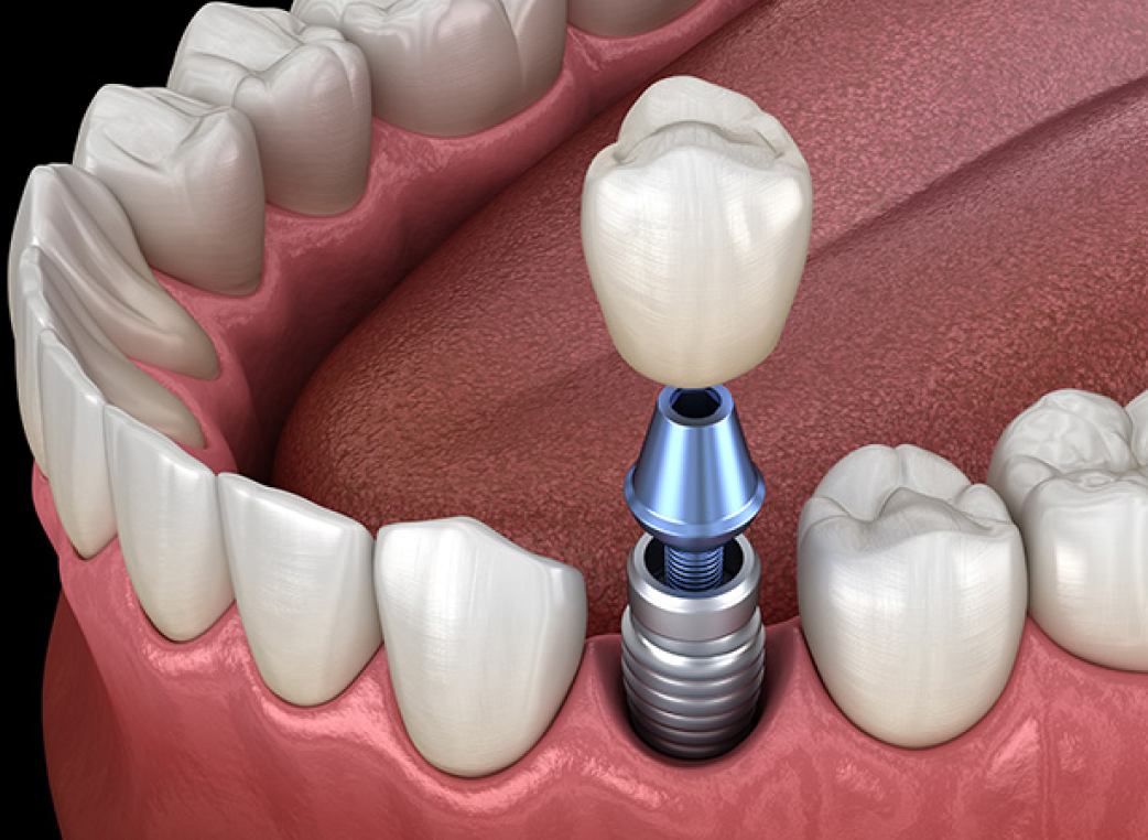 健康な歯を守ることができる