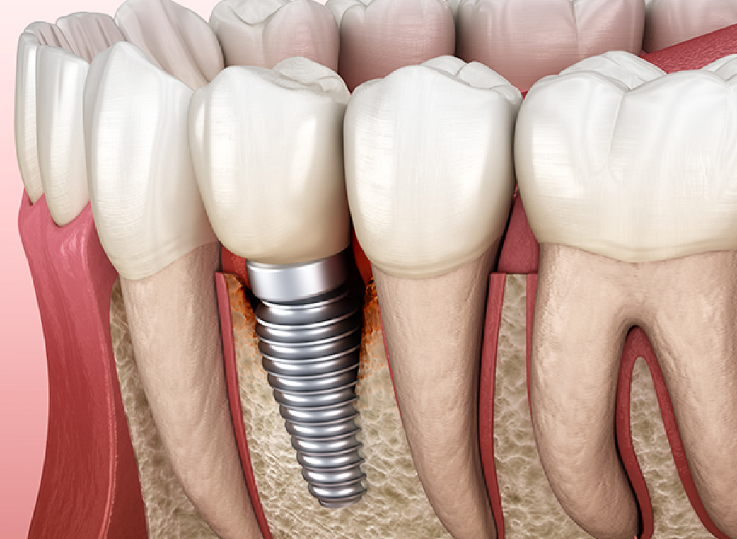 顎の骨を健康に保ちやすい